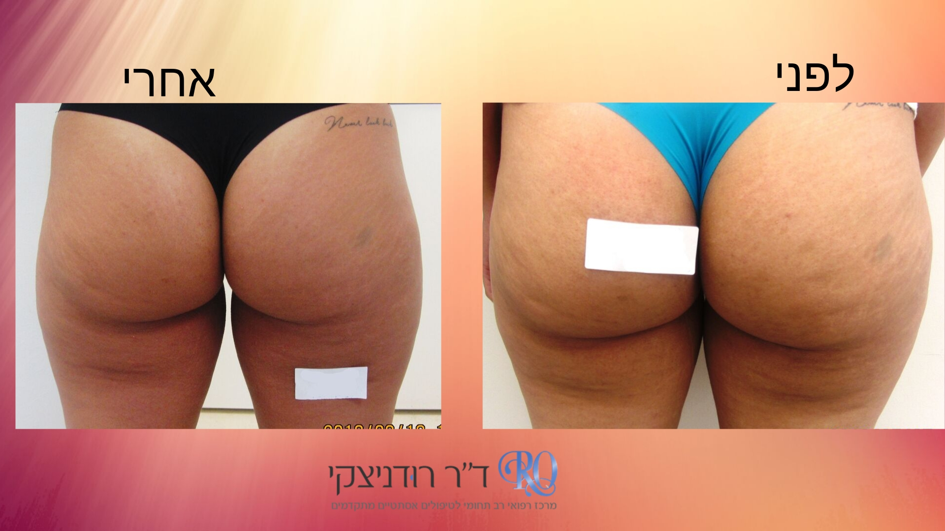 טיפול-בצלוליטיס